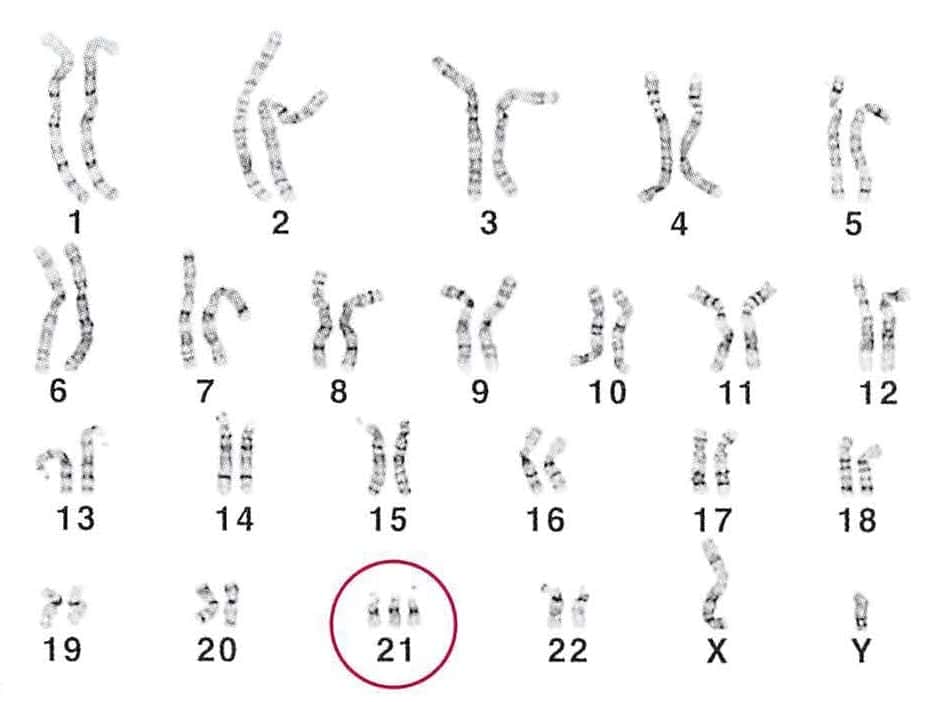 ダウン症（21トリソミー）の染色体検査結果