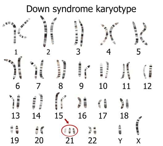２１番染色体のトリソミー