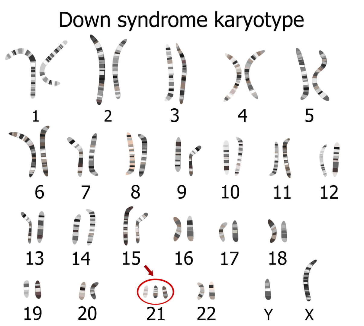 トリソミー21の染色体検査像