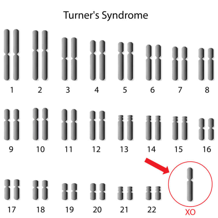 ターナー症候群の核型