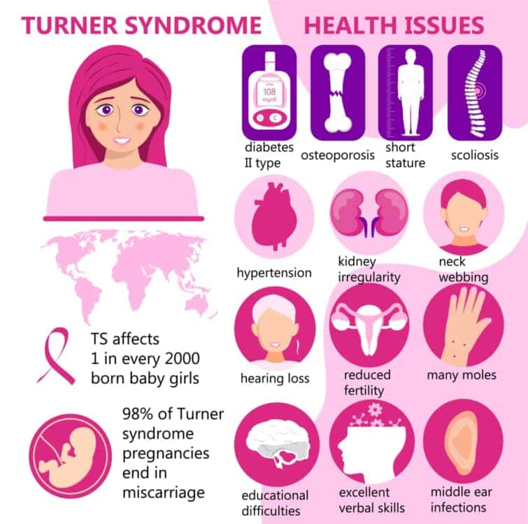 ターナー症候群のイメージ