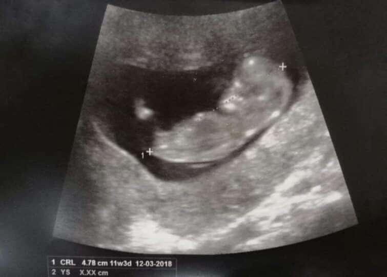妊娠3か月の赤ちゃんのエコー写真