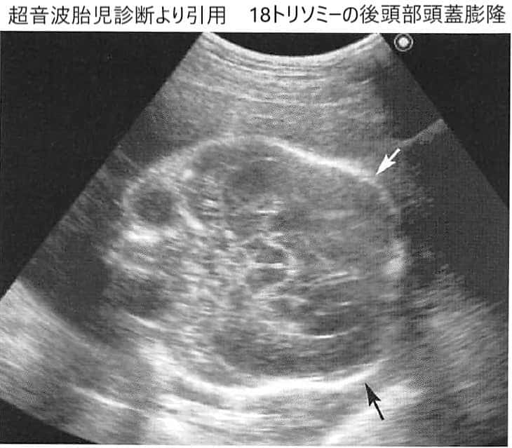 エコー 18 トリソミー 妊娠5ヶ月前の者です。先日ＮＨＫのＴＶで「エコーで胎児の異常が分る」特集