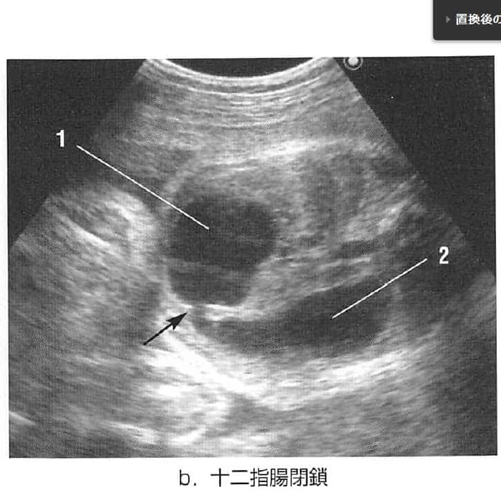 胎児十二指腸閉塞のエコー所見