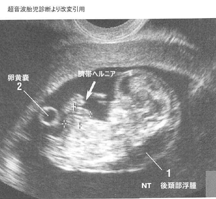 妊娠11週の胎児の臍帯ヘルニア