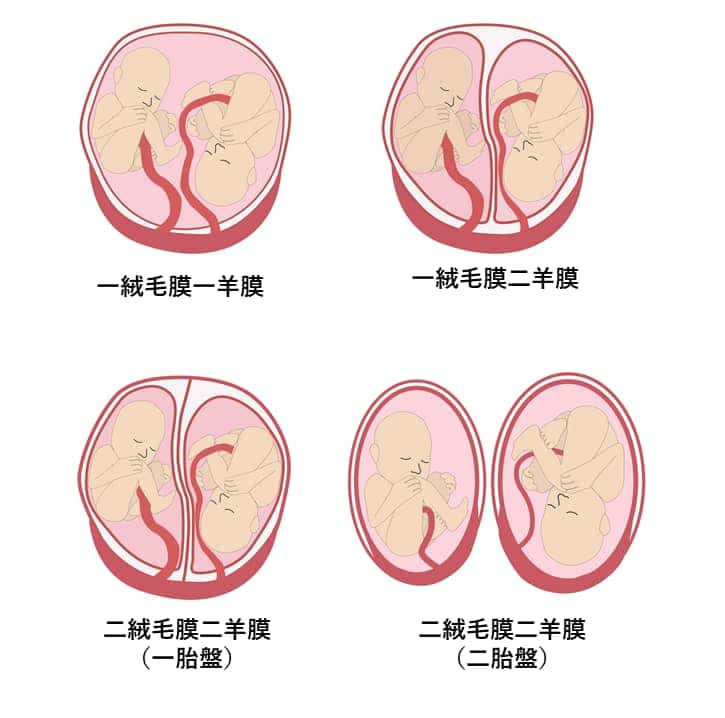 双胎の絨毛膜羊膜の数による分類