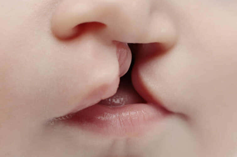 口蓋裂と口唇裂｜新生児の500人に一人｜ダウン症児など染色体異常の多くが合併