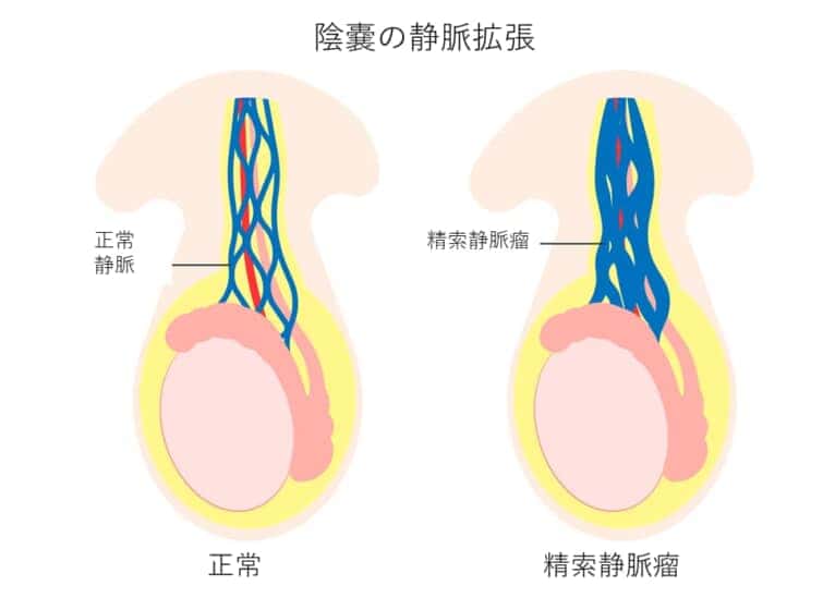 男性不妊の特徴 精液の見た目や陰嚢の形状で分かること