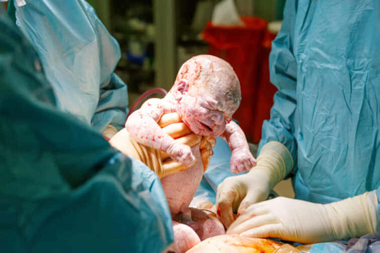 帝王切開で生まれた赤ちゃん。生まれたての子どもは生後数秒と数分