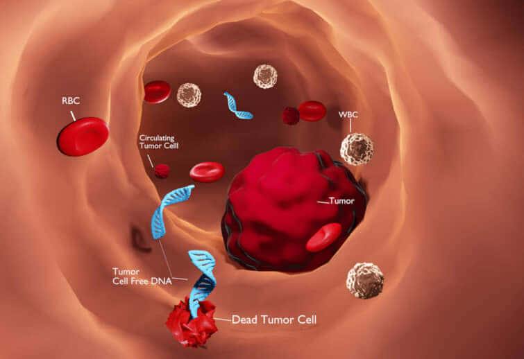 早期非小細胞肺癌診断・治療・術後の再発早期発見とリキッドバイオプシー