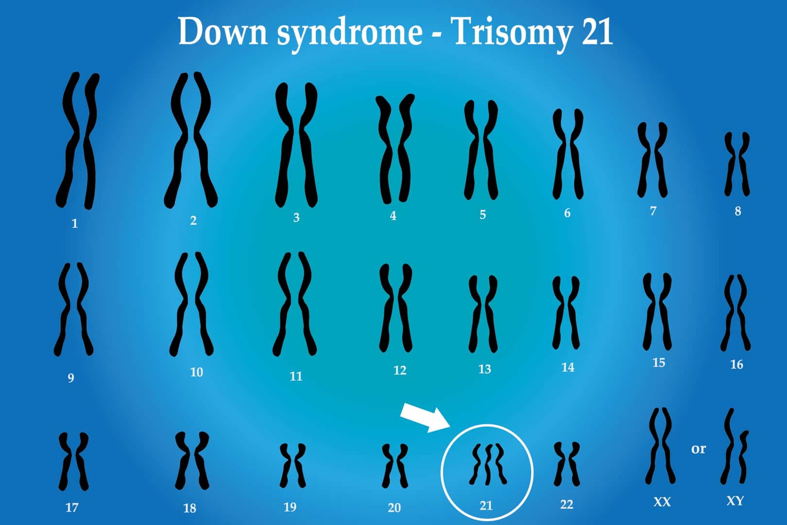 ダウン症の染色体異数性