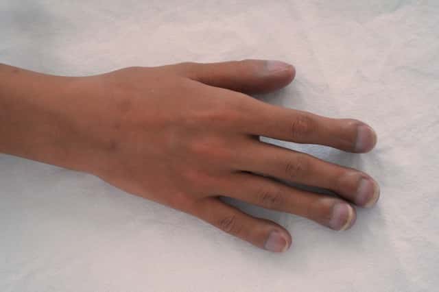 先天性チアノーゼ型心疾患の患者の右手。バチ指の典型的な特徴。指が特徴的。