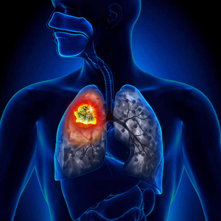 肺がんのリキッドバイオプシーに含まれる遺伝子