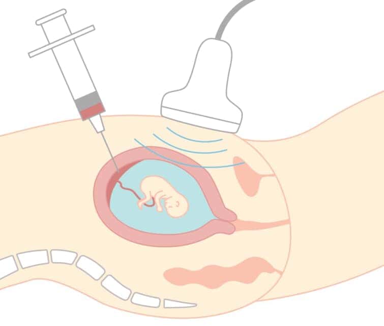 出生前診断。絨毛膜組織検査。 妊娠中の女性の胃の横から見たイラスト