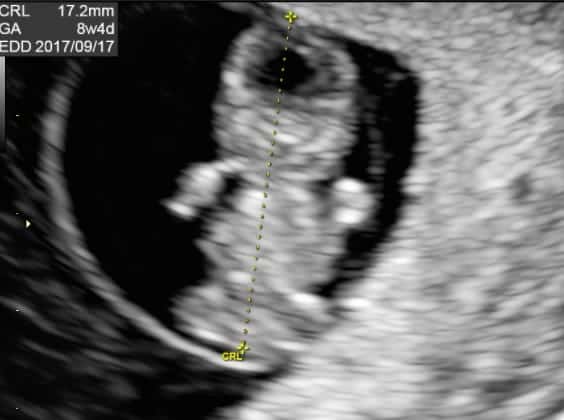 妊娠8週目の超音波写真