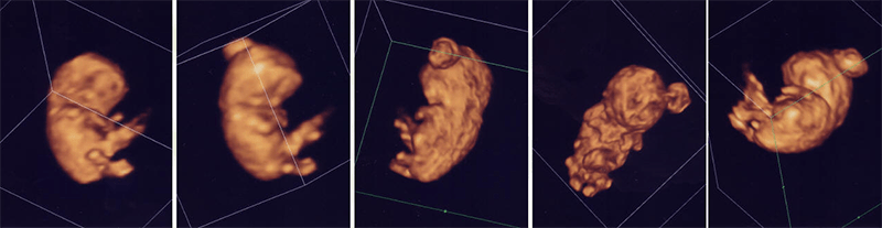 妊娠9週目の胎児のエコー写真