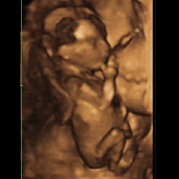 妊娠15週目の赤ちゃんの3D・4Dエコー写真