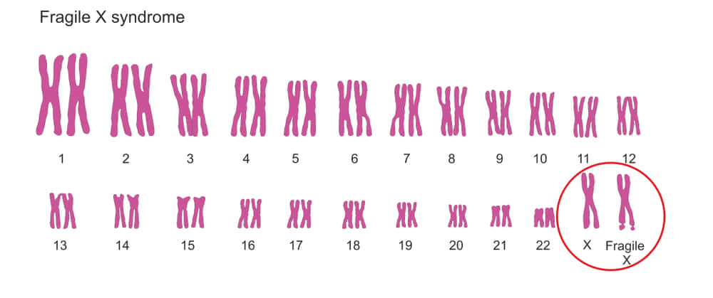 脆弱X症候群の染色体核型