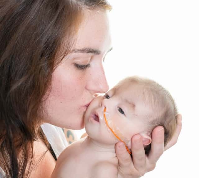 若い母親が栄養チューブで特別なニーズを持つ乳児の頬にキスをする接写