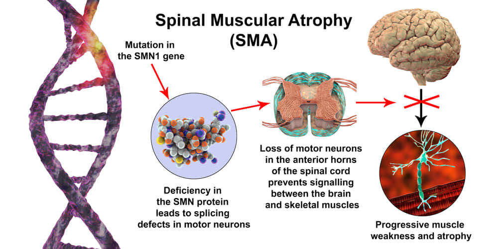 脊髄性筋萎縮、SMA、SMN1遺伝子の突然変異による進行性筋肉の消耗、SMNタンパク質の欠乏、運動ニューロンの喪失