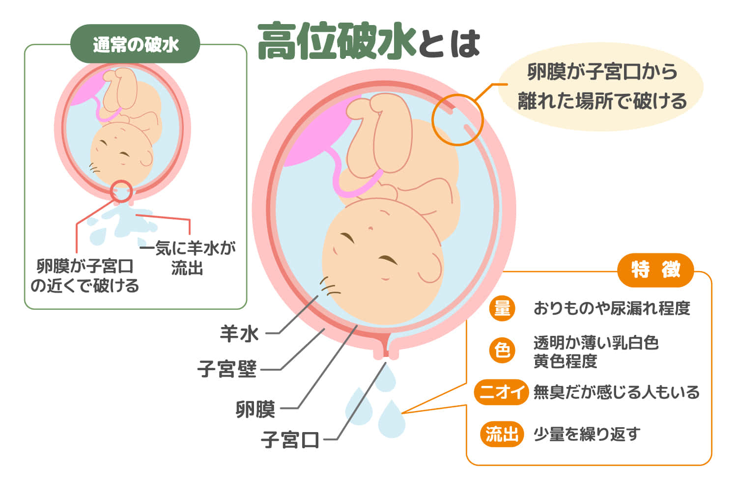 高位破水とは 原因や破水との違いを詳しく解説