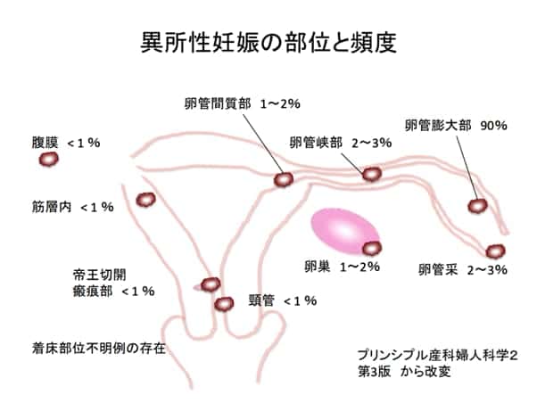 子宮外妊娠は痛い 原因や症状を知り受診が必要か検討しよう