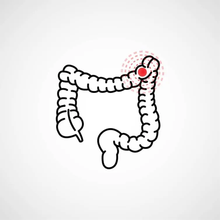 大腸がん切除後のフォローアップ（サーベイランス）と循環腫瘍DNA