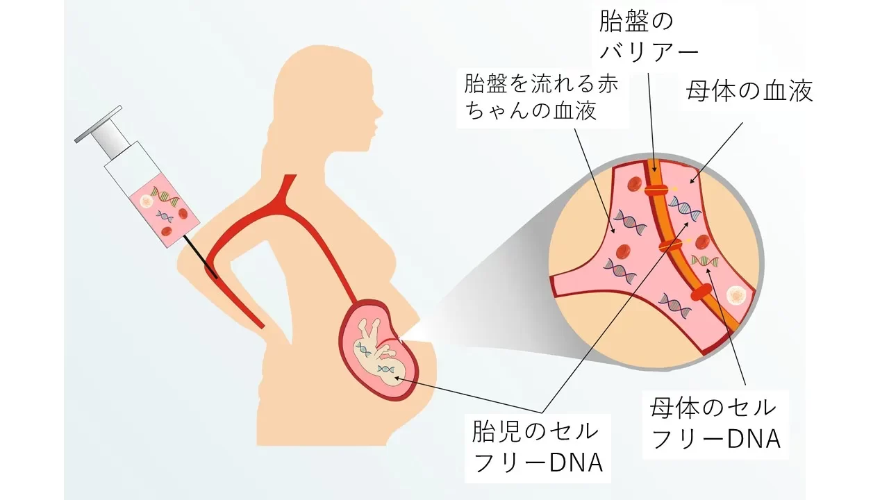 NIPT（新型出生前診断）