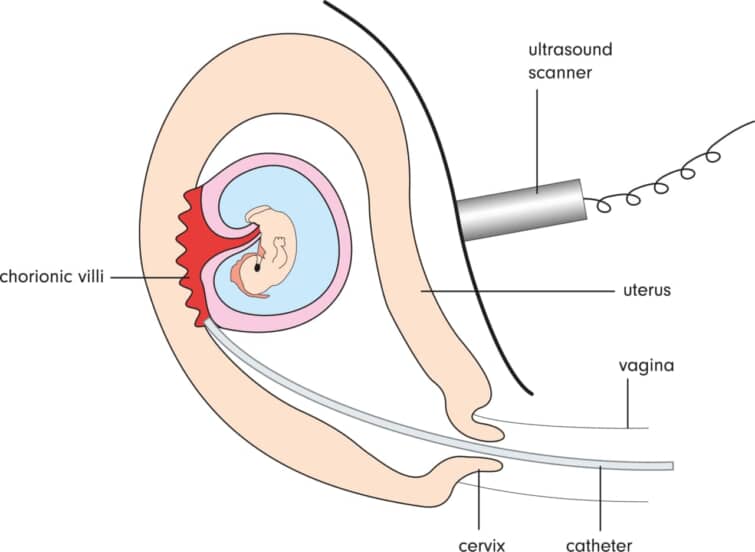 羊水検査と絨毛検査の違い｜費用やリスクなどを徹底比較