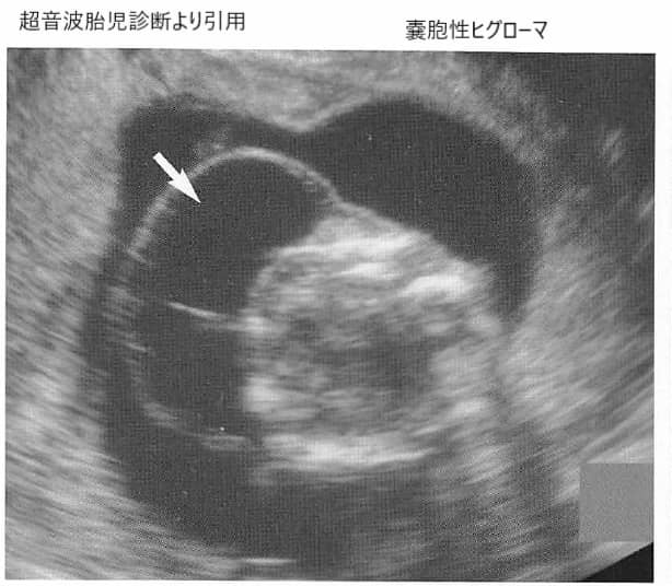 嚢胞性ヒグローマ