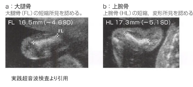 胎児の大腿骨と上腕骨の短縮を示す超音波(エコー)画像。『実践胎児超音波検査』より引用