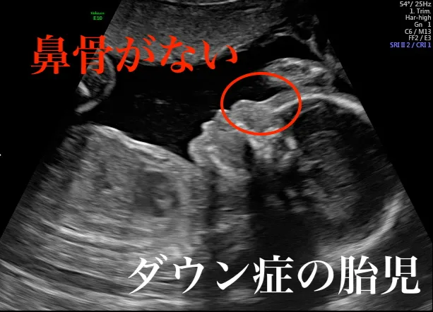 ダウン症の胎児の鼻骨