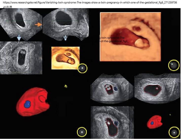 バニシングツインの超音波画像
