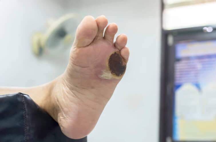 糖尿病で足が壊死した人