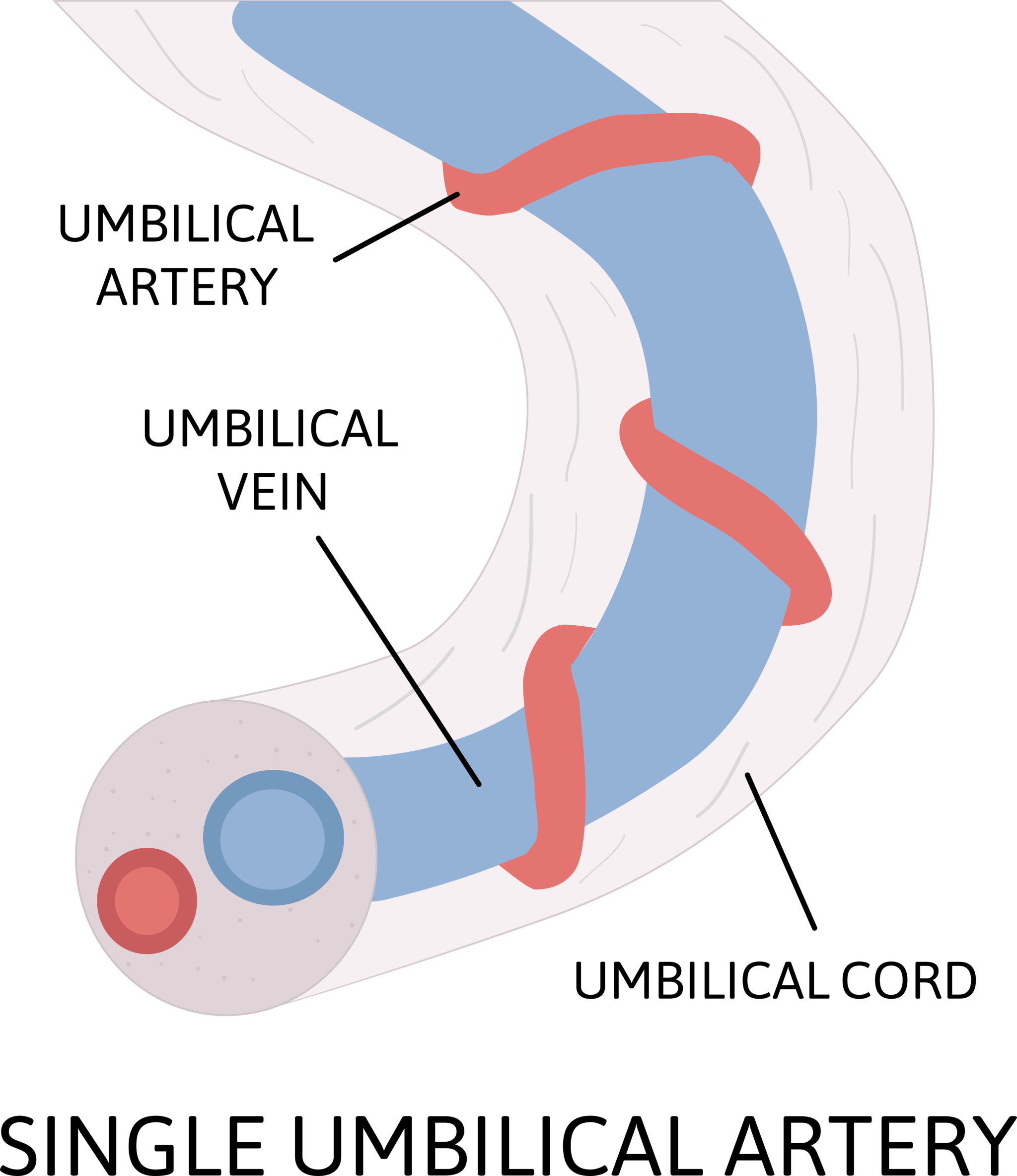 単一臍帯動脈