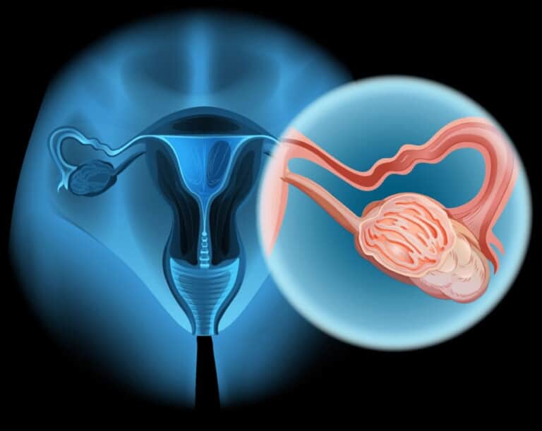 卵巣嚢腫の腰痛にはどのような治療法がありますか?