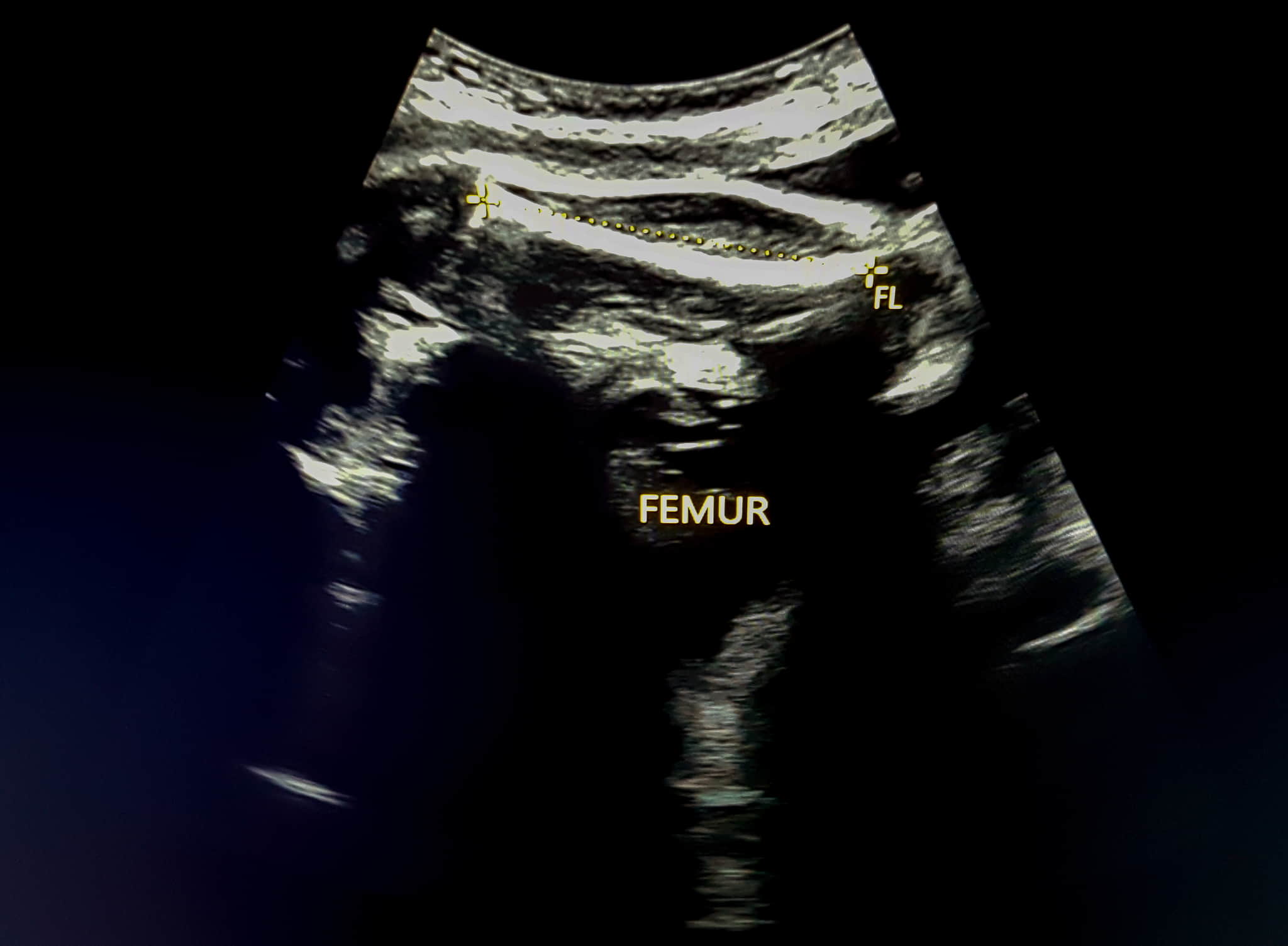 胎児大腿骨の超音波画像