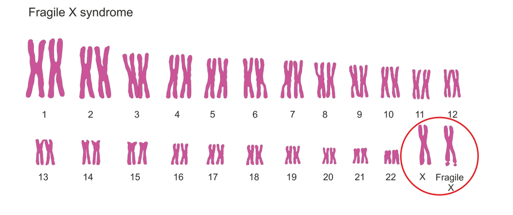 脆弱X症候群の染色体核型