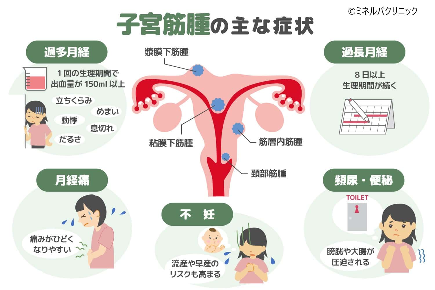 子宮筋腫の症状・診断・治療方法をわかりやすく解説