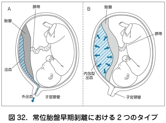 胎盤の基礎|完成時期や役割・妊娠中の胎盤トラブルと予防法を解説【妊娠初期の方へ】