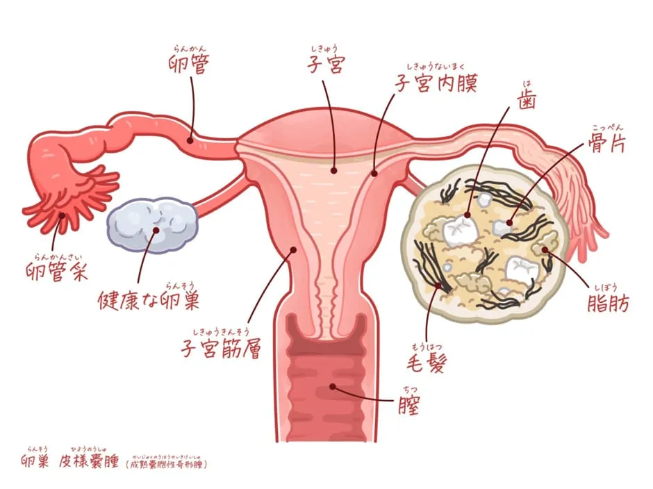 卵巣皮様嚢腫の説明図