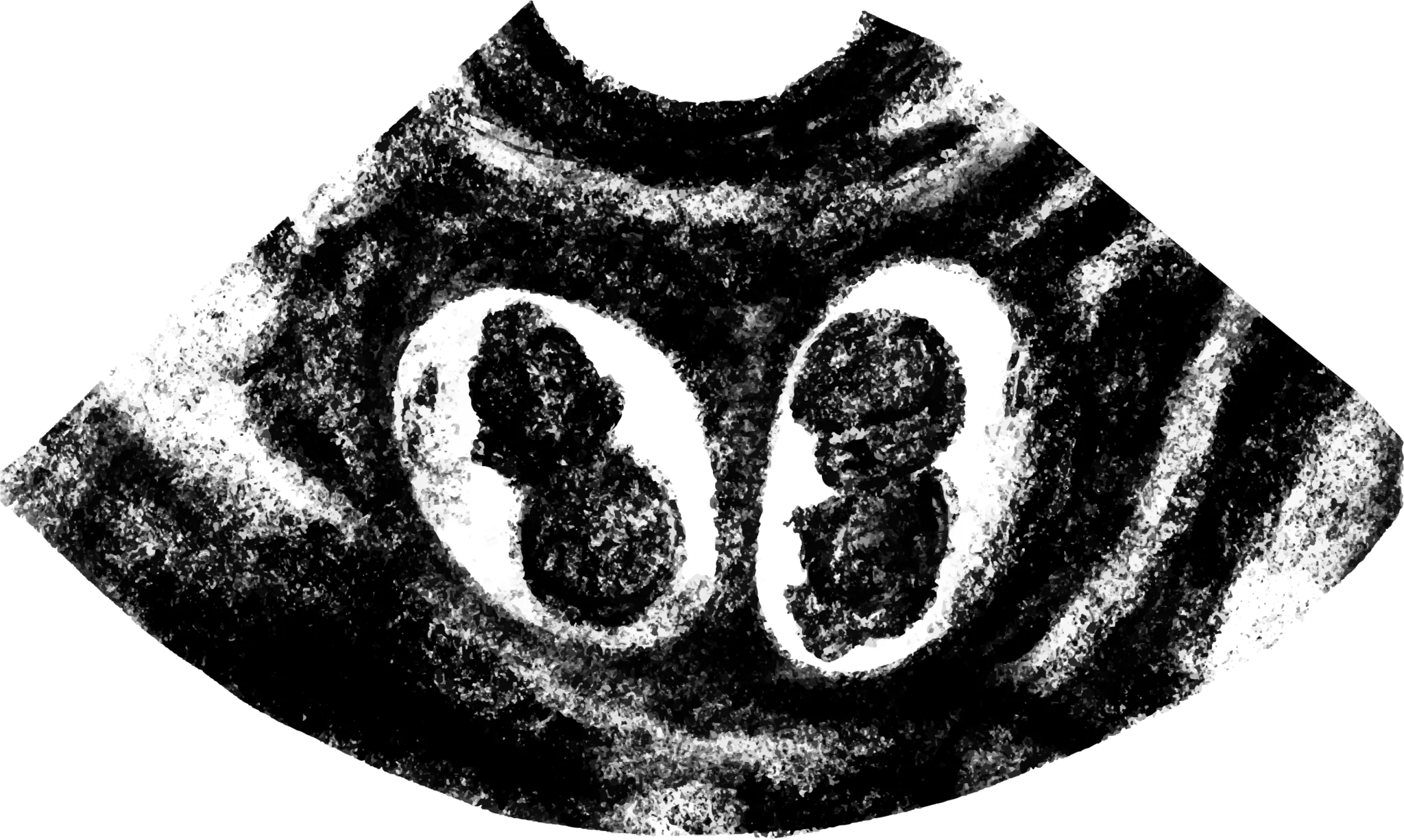 双子の胎児の超音波画像