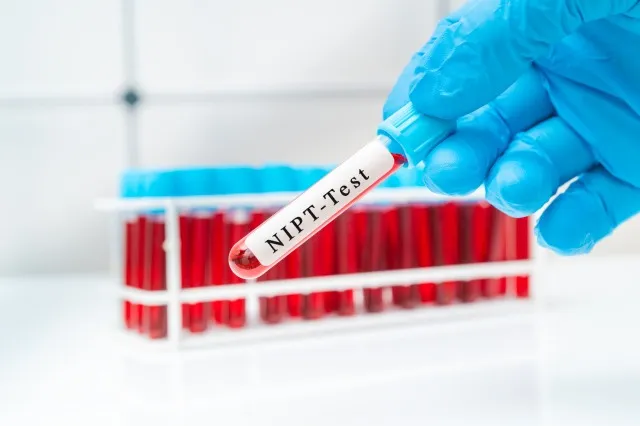 NIPT 出生前検査、妊娠中の女性のダウン症候群の診断のための医師の手で血液サンプル試験管