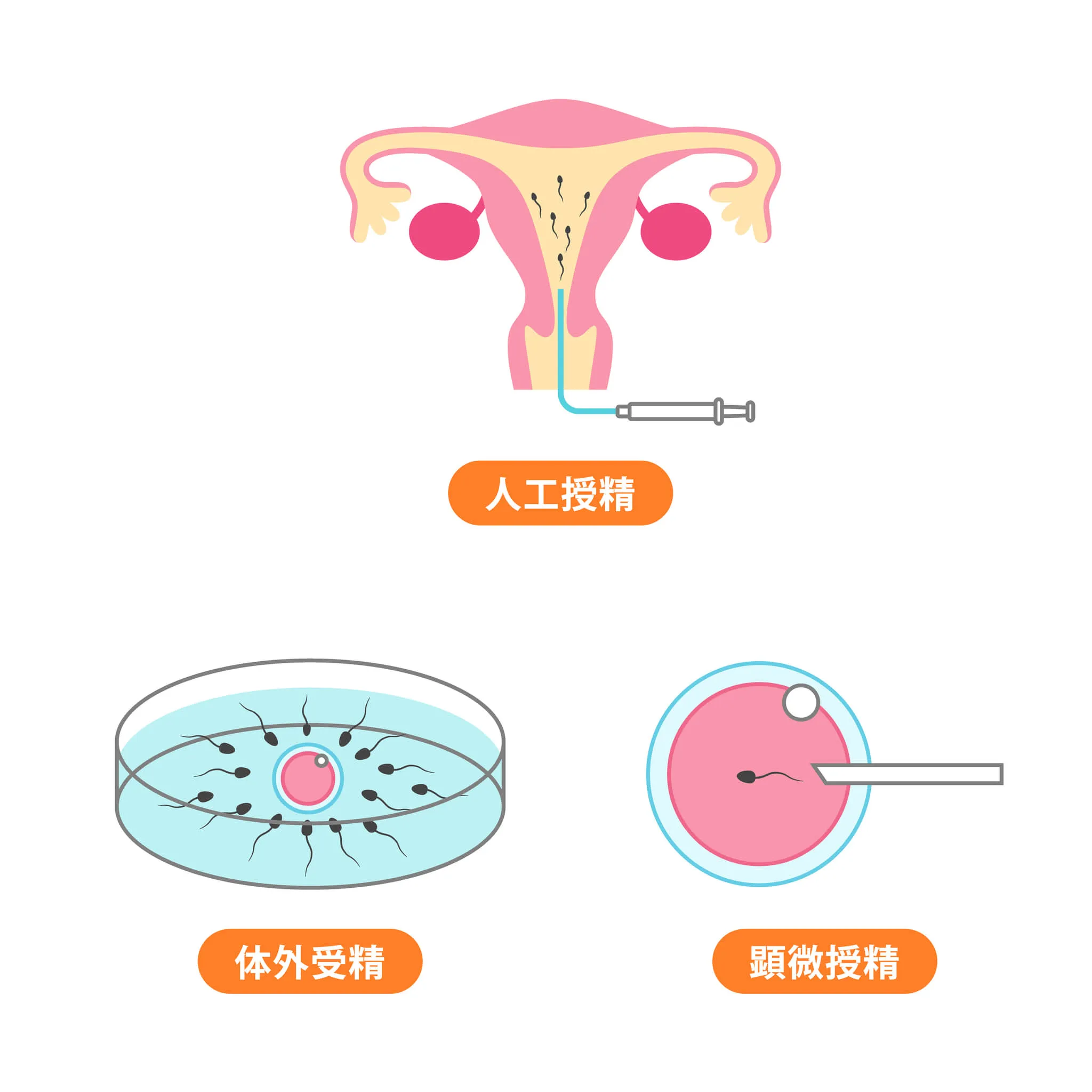 人工授精、体外受精、顕微授精のイラスト