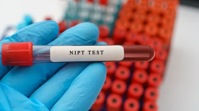 NIPT または非侵襲的出生前検査、医療ラボで医師の手で試験管に血液サンプルを使用した胎児ダウン症候群検査結果の診断