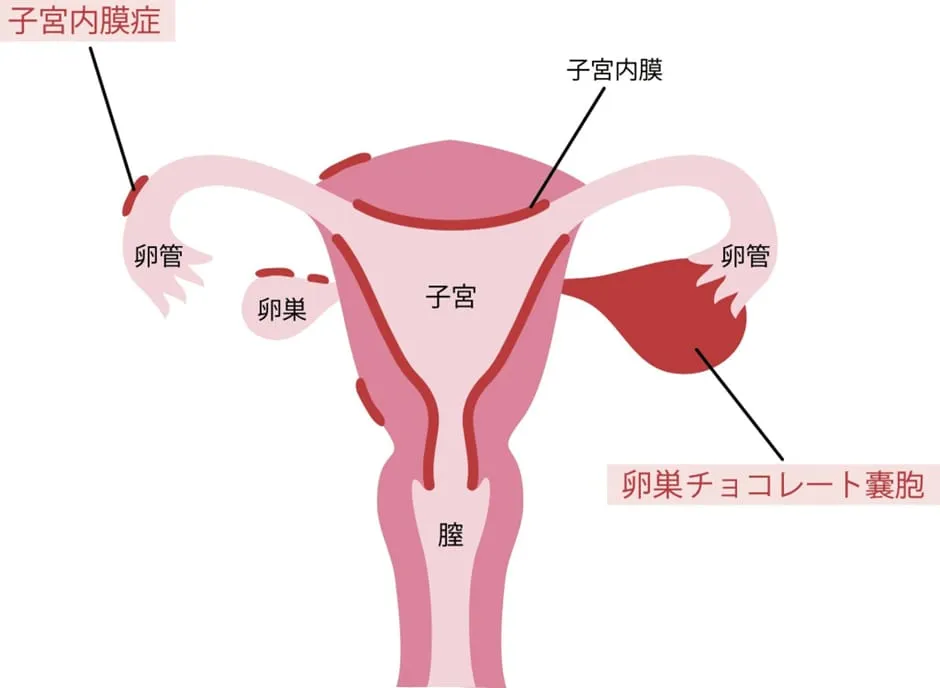 卵巣と子宮のイメージイラスト画像