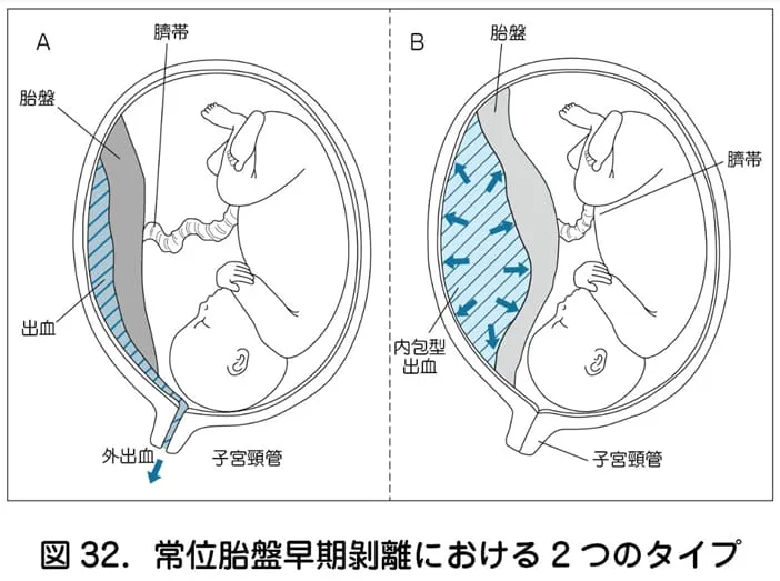 常位胎盤早期剥離の図