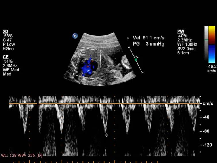 胎児の心臓超音波検査写真