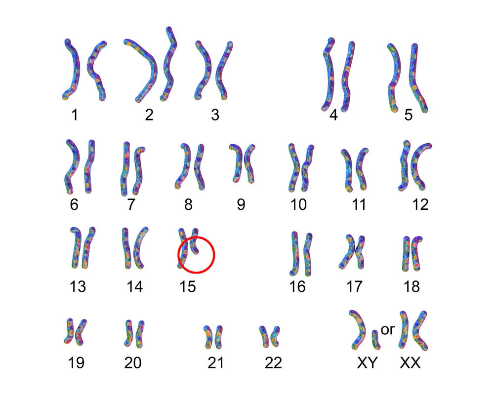 プラダー・ ウィリ症候群の核型。父から受け継がれた染色体15の一部の機能の欠如に起因する遺伝性疾患
