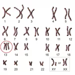 トリソミー13の染色体検査イメージ画像